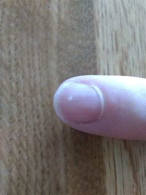 This hair splinter under my nail : r/mildlyinfuriating