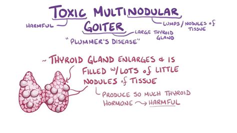 Nontoxic Multinodular Goiter Causes Symptoms Treatment