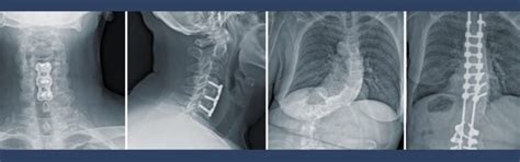 Thoracic Disc Herniation - Neurosurgery