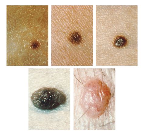 How To Know When Your Moles Are Becoming Cause For Concern