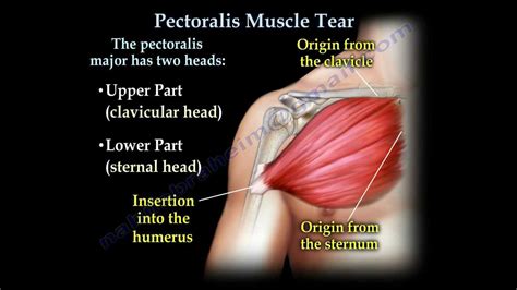 Torn Pectoral Muscle Pictures : How Not To Tear A Pec While Bench ...