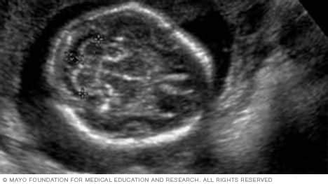 Fetal Brain Ultrasound Images