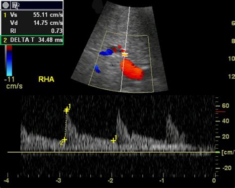 Normal hepatic artery. Spectral Doppler image in a liver transplant ...