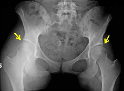 PAO surgery in young female patient with hip dysplasia - John C ...