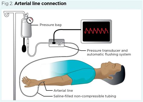 Indwelling Arterial Catheter