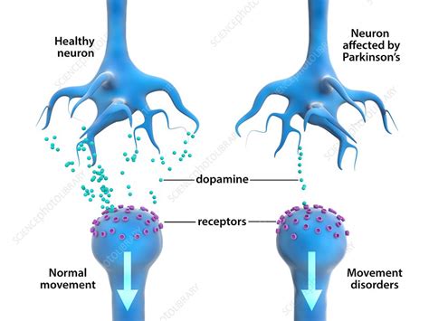 Parkinson's Disease Dopaminergic Neurons - Captions Update Trendy