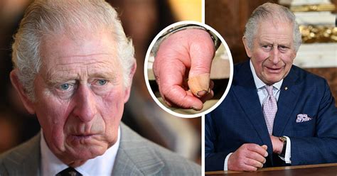 King Charles’ ‘sausage fingers’: Doctor claims they have gotten worse ...