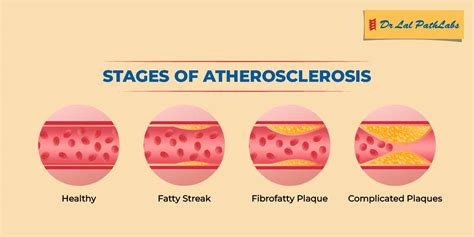 Atherosclerosis: Symptoms & Diagnosis - Dr Lal PathLabs Blog