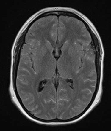 Viral meningitis | Radiology Reference Article | Radiopaedia.org