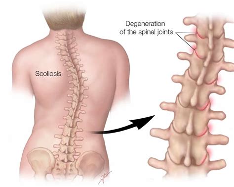 Scoliosis Types - Dr. Michael A. Castillo, MD