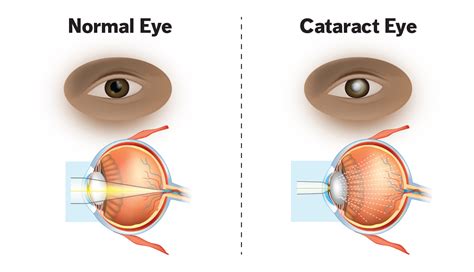 Cataract: Causes, Symptoms and Treatment | Hyzape