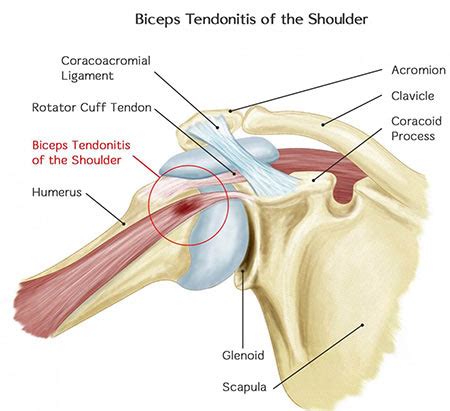 Bicep Tendonitis Treatment NYC | Bicep Tendonitis Specialist