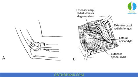 Tennis Elbow Surgery | OrthoFixar 2024