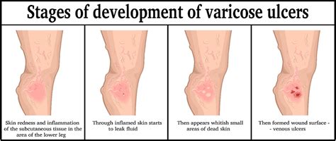 Venous Leg Ulcers Treatment - New York Vein Treatment Center