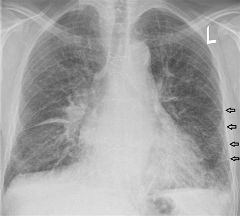 Posterior Anterior Chest Radiograph Acute Pulmonary Edema Download ...