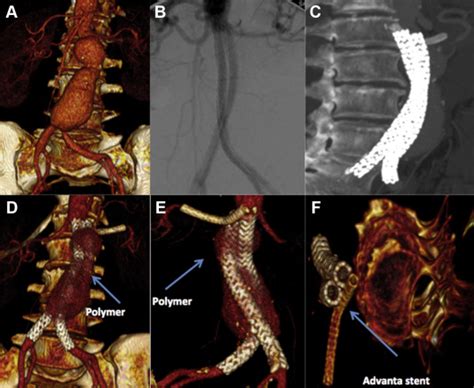 Treatment of a Juxtarenal Aneurysm with a Parallel Graft in the Left ...