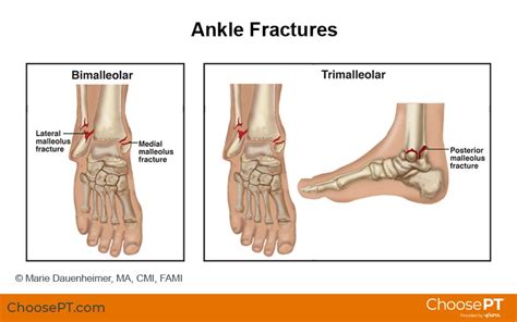 Guide | Physical Therapy Guide to Ankle Fracture | Choose PT