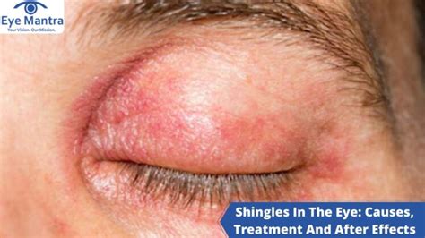 Shingles In The Eye: Causes, Treatment And After Effects