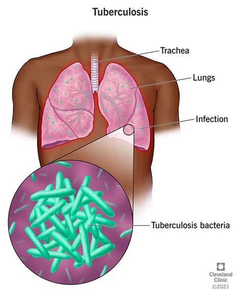 Tuberculosis: Causes, Symptoms, Diagnosis & Treatment