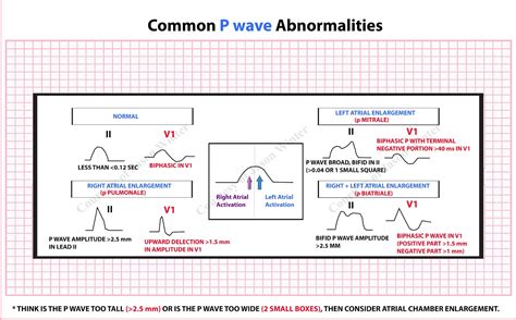 ECG Educator Blog : P wave Abnormalities