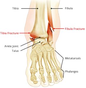 Ankle Fracture Treatment Broward & Palm Beach | Florida Foot & Ankle