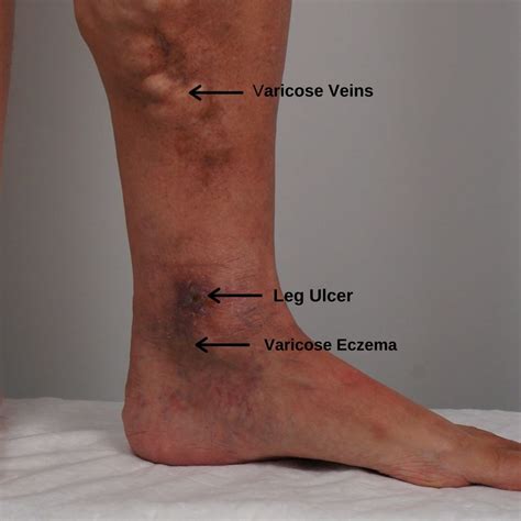 Varicose Eczema | The VeinCare Centre