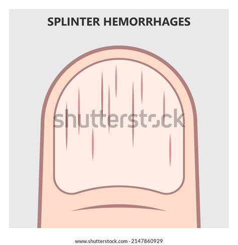 Splinter Hemorrhages: Over 14 Royalty-Free Licensable Stock Vectors ...