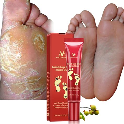 Beriberi paste Nail Treatment Onychomycosis Paronychia Anti Fungal ...