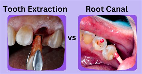 Comparing Tooth Extraction vs Root Canal: What's the Difference? | Sri ...