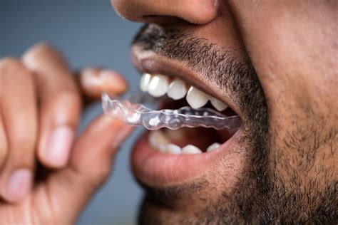 Invisalign vs. Clear Aligner Kit | How To Get Straight Teeth