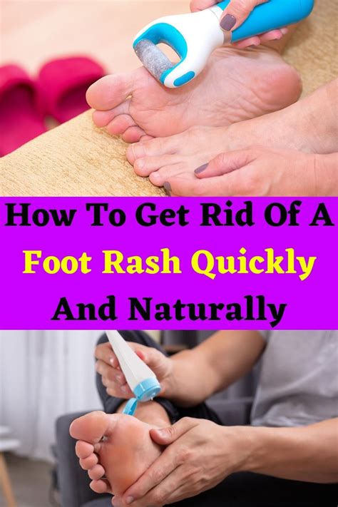 How To Get Rid Of A Foot Rash Quickly And Naturally in 2021 | Foot rash ...