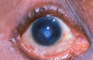 Corneal Ulcer Treatment Through Natural Home Remedies