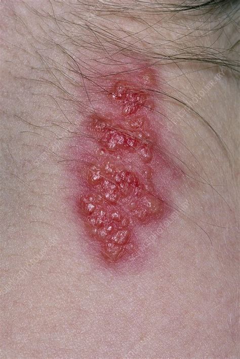 Shingles Rash