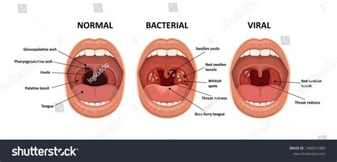 Pharyngitis: Over 867 Royalty-Free Licensable Stock Vectors & Vector ...