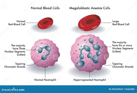 Blood Cells with Megaloblastic Anemia Stock Vector - Illustration of ...