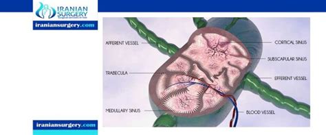 Lymph nodes removal surgery - Iranian Surgery