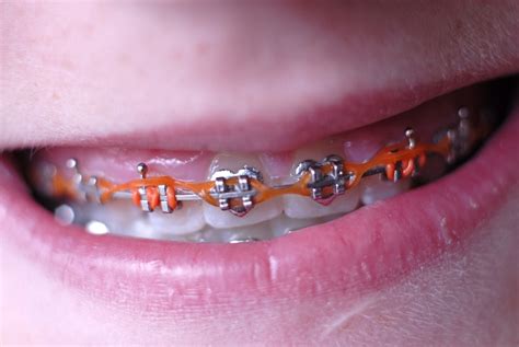 Everything You Need to Know About Elastics for Braces - Orthodontic ...