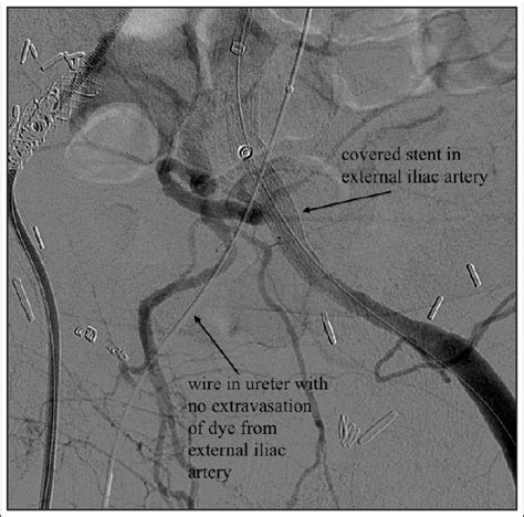 Iliac arteriogram after deployment of an external iliac artery stent ...