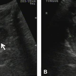 (A) Transverse ultrasound of patient demonstrating a hypoechoic lesion ...