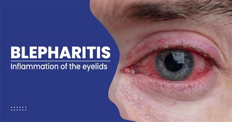 Blepharitis – Symptoms, Causes, Treatment, And Prevention