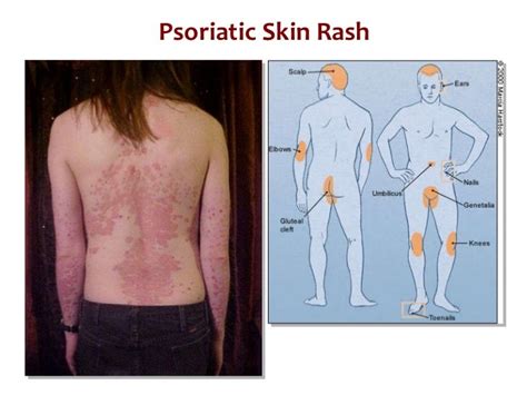 rheumatoid arthritis rash - pictures, photos