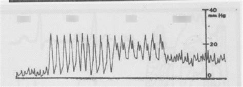 Pulmonary Artery Catheter Waveforms Diagram | Quizlet