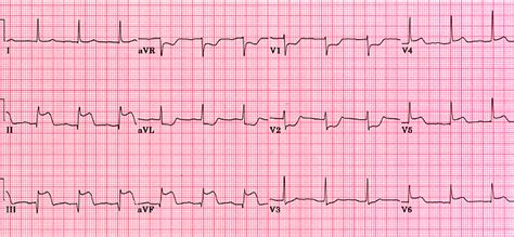 Posterior Myocardial Infarction Ecg