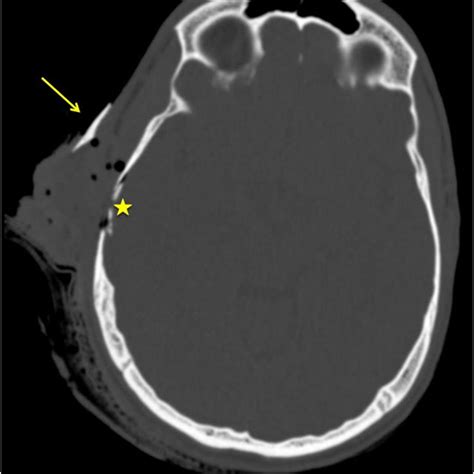 Computed tomography. Asterisk: skull fracture; arrow: dislocated bone ...