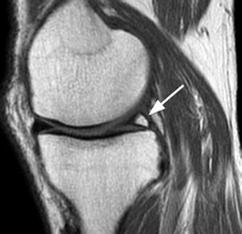 Meniscal Cysts - Knee & Sports - Orthobullets