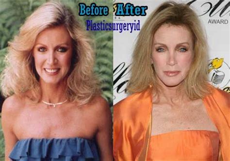 Donna Mills Before and After Plastic Surgery Photos