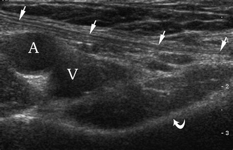 Indirect Inguinal Hernia Ultrasound