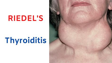 RIEDEL'S THYROIDITIS (Rock Hard Thyroid): Stony Hard Woody Thyroid ...