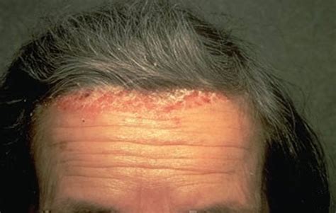 Scalp Psoriasis - Causes &Treatment Options, Natural & Home Remedies