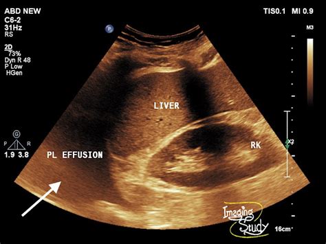 Imaging Study: Pleural Effusion Ultrasound